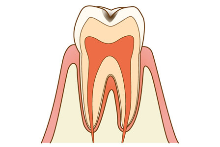 C1【エナメル質の虫歯】