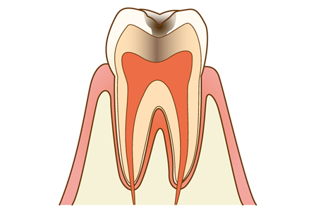 C2【象牙質の虫歯】
