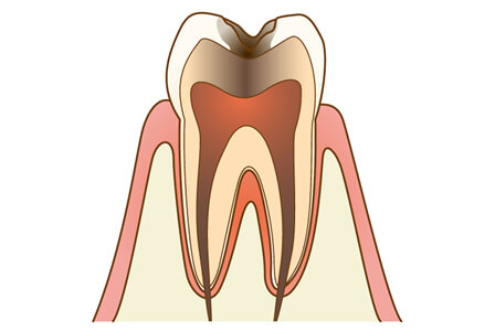 C3【神経に達した虫歯】