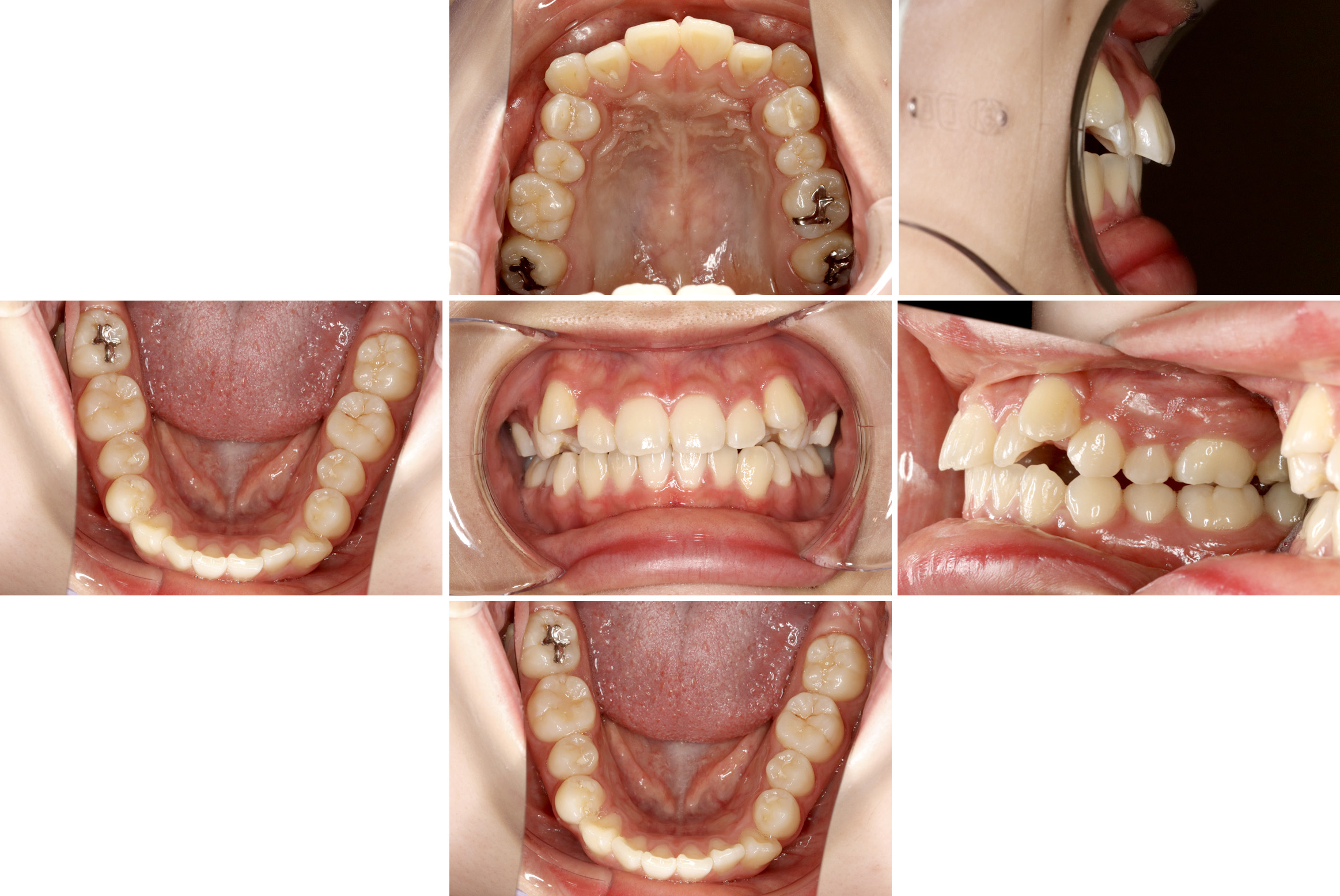 矯正治療の症例